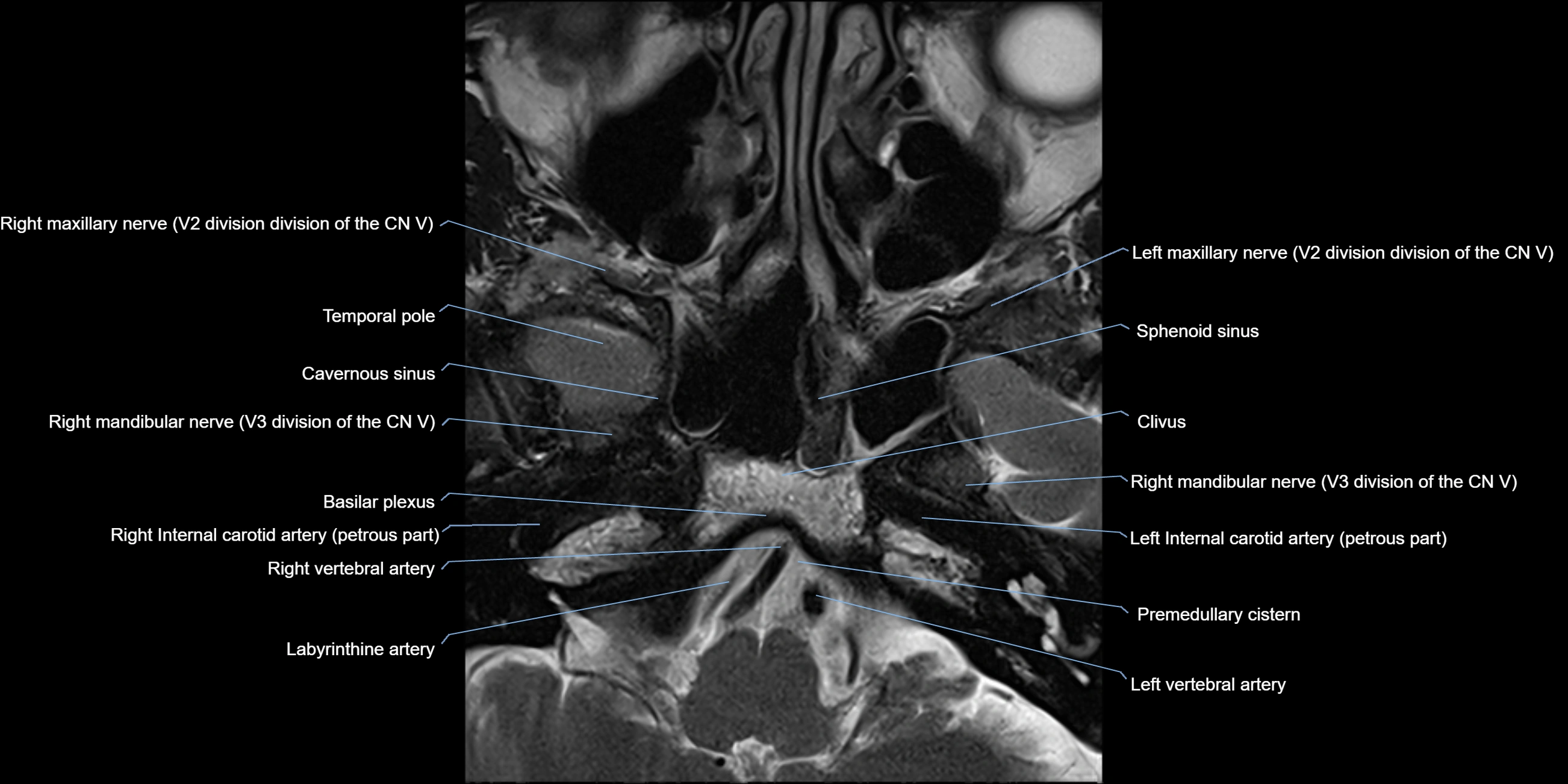 MRI cavernous sinus axial cross sectional 3T anatomy image-img-11001-00002.webp